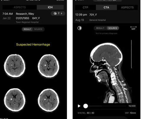 AI- tool can detect pulmonary embolism early